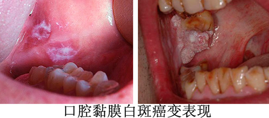 口腔白斑 (50)