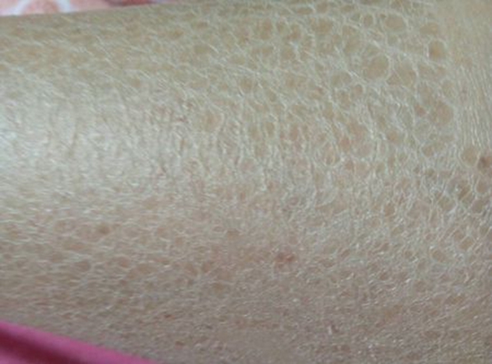 魚(yú)鱗皮膚病 (45)