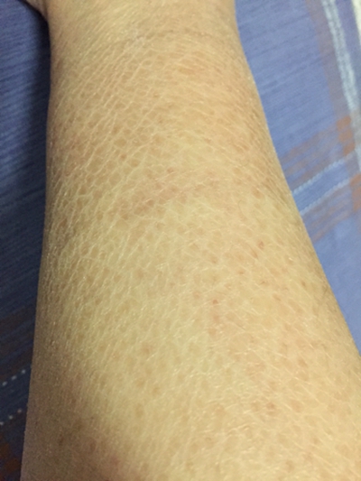 魚鱗皮膚病 (48)
