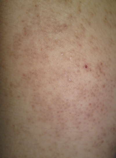 魚鱗皮膚病 (50)