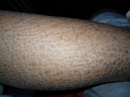 魚(yú)鱗皮膚病 (37)