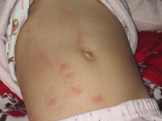 小兒蕁麻疹 (40)