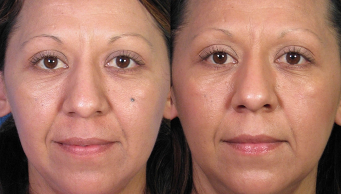 激光祛痣恢復(fù)過程圖 (33)