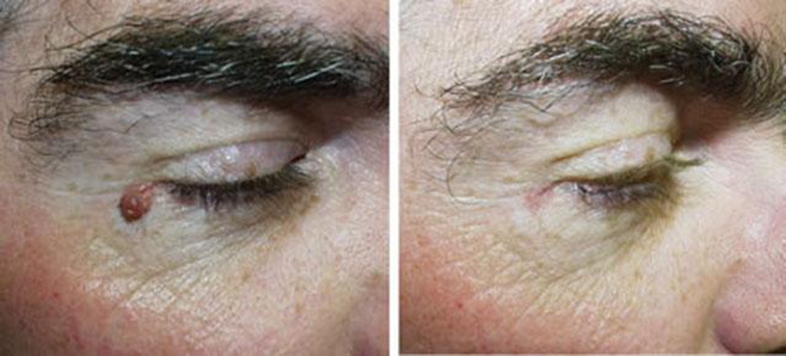 激光祛痣恢復(fù)過程圖 (47)