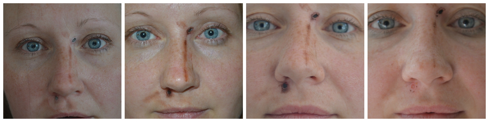 激光祛痣恢復(fù)過程圖 (41)