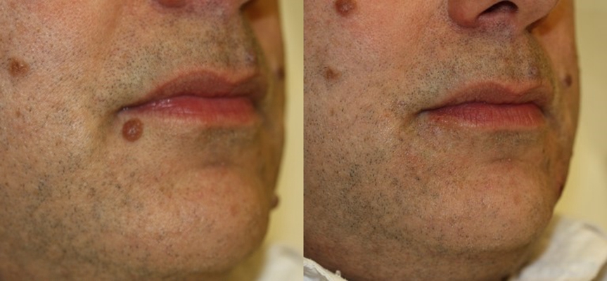 激光祛痣恢復(fù)過程圖 (44)