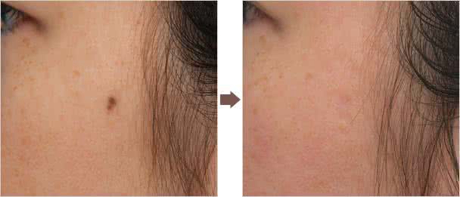 激光祛痣恢復(fù)過程圖 (5)