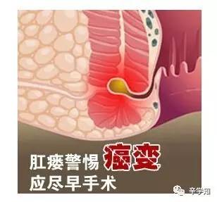 4,肛瘘癌变