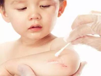 磕肿了,擦破了,处理宝宝各种皮肤内外伤_鲍秀兰_中华康网