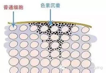 色素沉着是人体皮肤由于种种原因而致皮肤呈现不同颜色,不同范围及不
