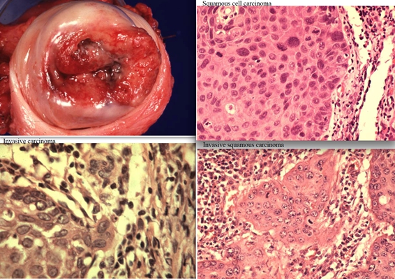 宮頸癌圖片 (34)