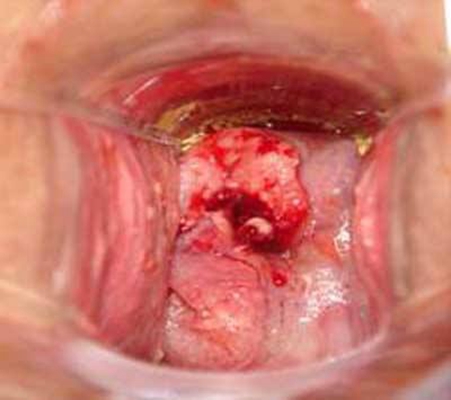 宮頸癌圖片 (37)