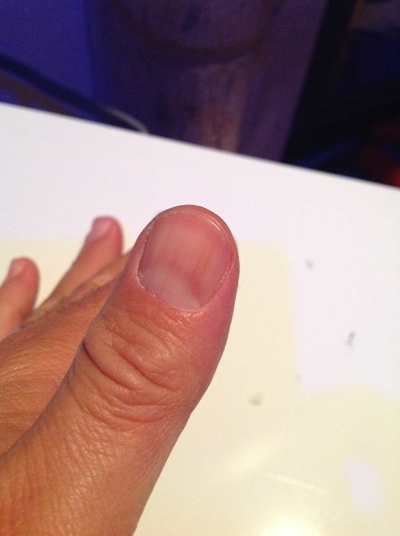大拇指指甲上有竖纹 (5)