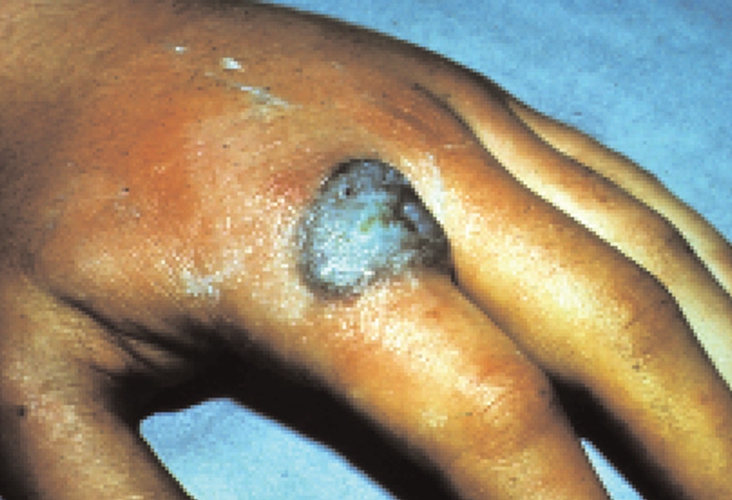 疣状皮肤结核病早期的症状的图片