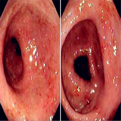 潰瘍性結(jié)腸炎多方位圖片