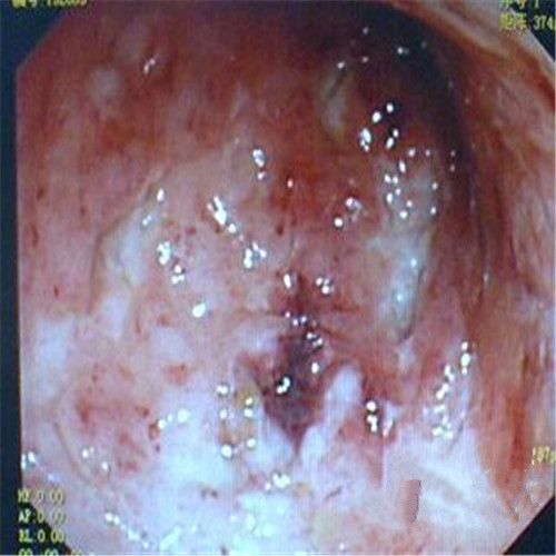 潰瘍性結(jié)腸炎出血圖片