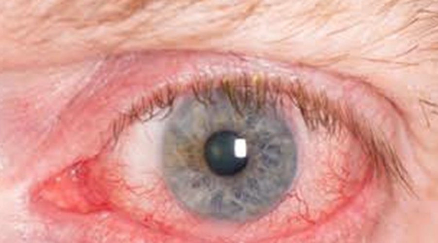 眼睛的结膜炎症状图片