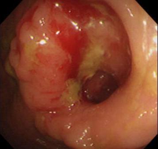 右半结肠癌腺癌浸润型常见临床特点图片