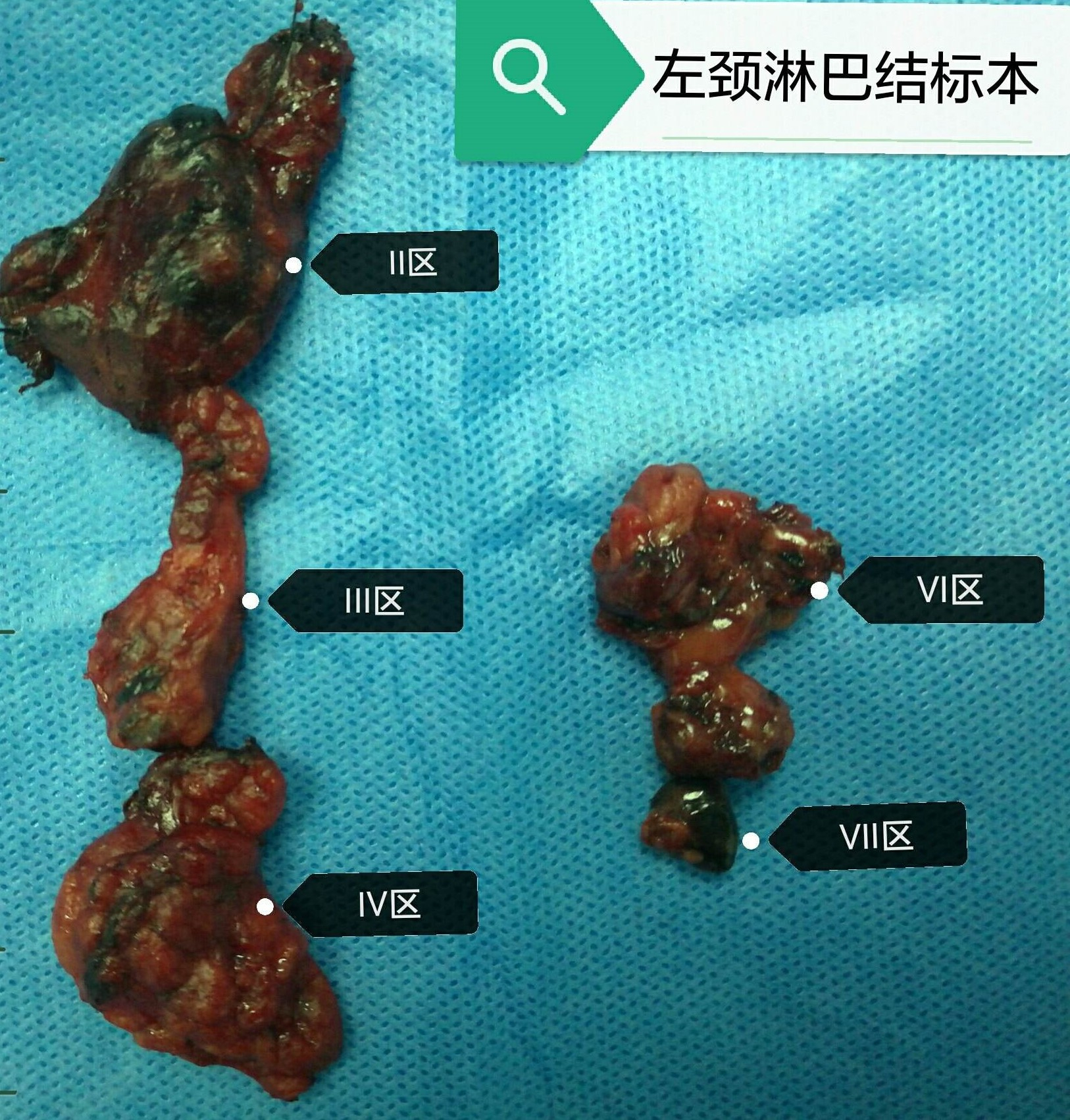 乳腺癌的早期症状 如何判断 - 学堂在线健康网