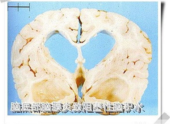 阻塞性脑积水图片