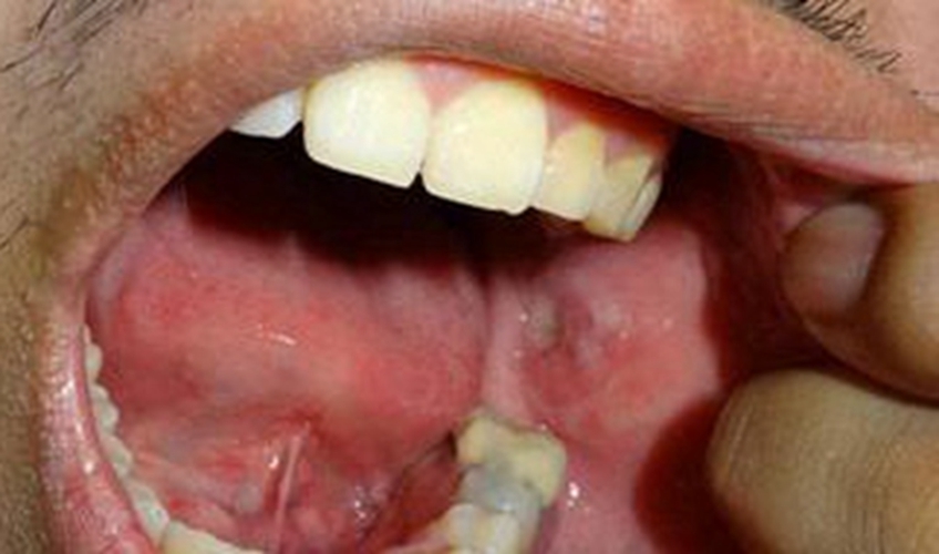 口腔癌的早期的症状图片