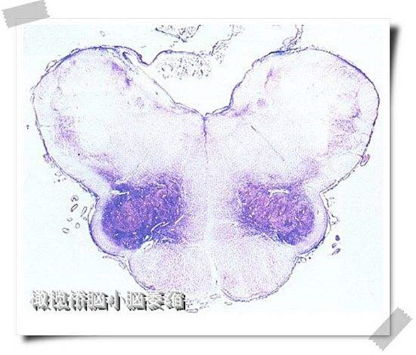 橄榄桥脑脑萎缩图片