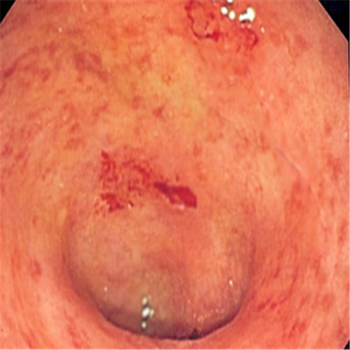 潰瘍性結(jié)腸炎表皮出血圖片