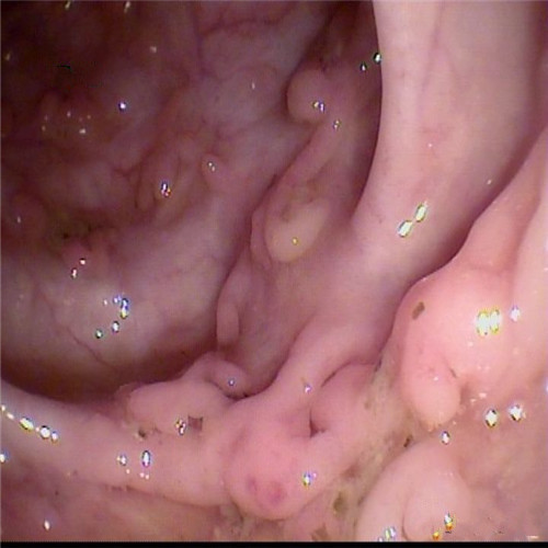 潰瘍性結(jié)腸炎側(cè)壁直觀圖片