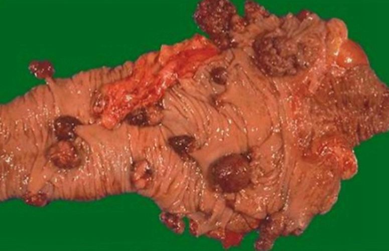结肠癌的症状图片