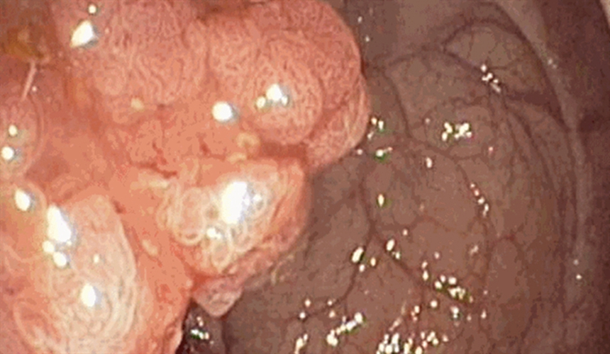 右半结肠癌未分化癌常见临床特点 图片