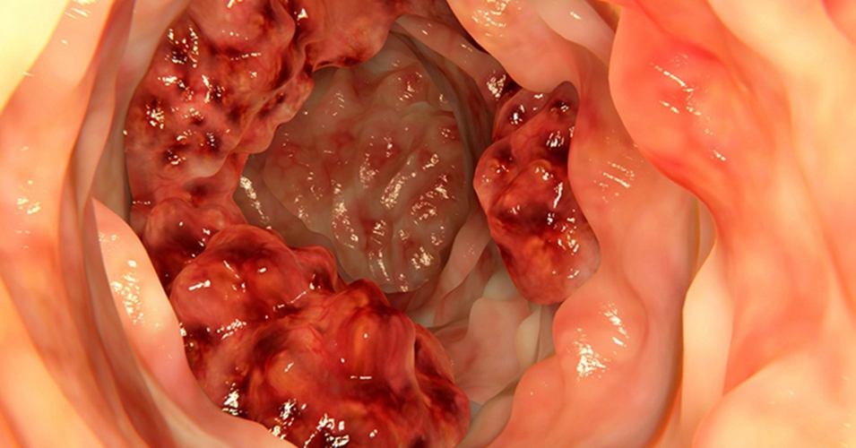 右半结肠癌腺癌三级常见临床 特点图片