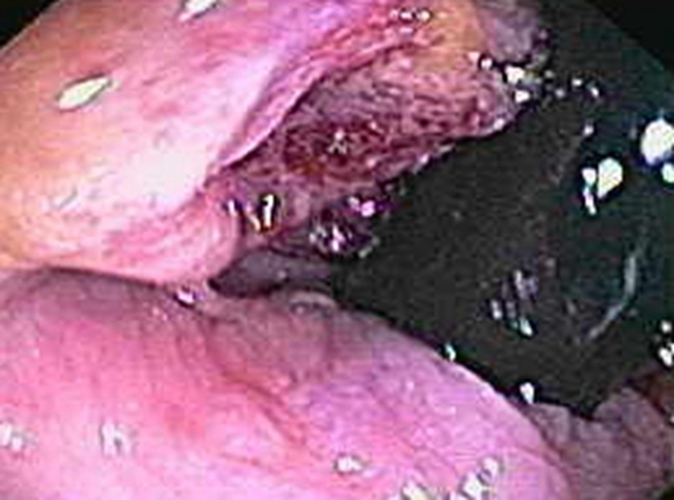 右半结肠癌圆形未分化癌常见 临床 特点 图片