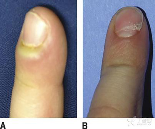 手指甲沟炎初期图片