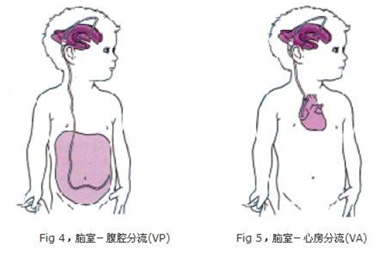 脑积水