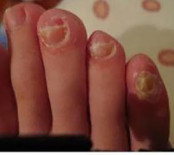 指甲癣的症状图片