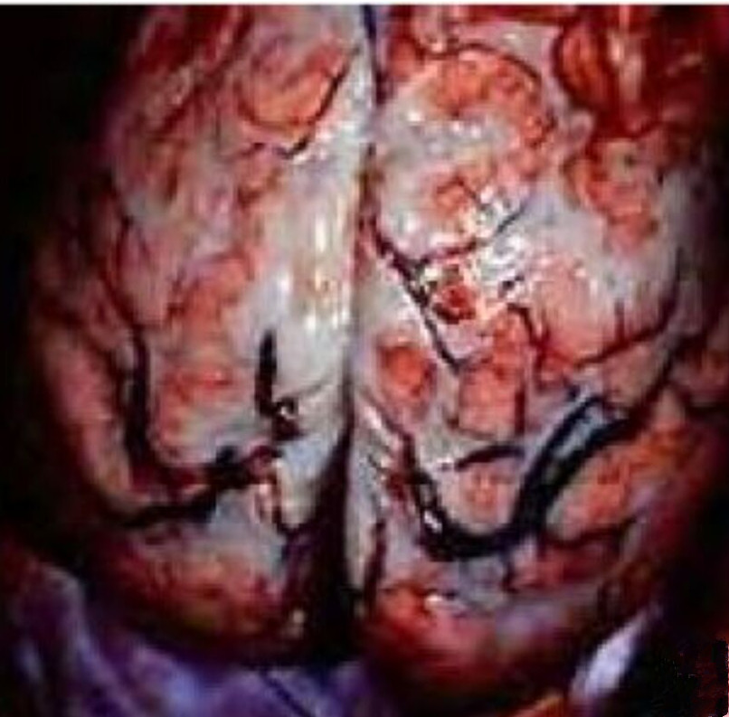 生理解剖脑膜炎图片