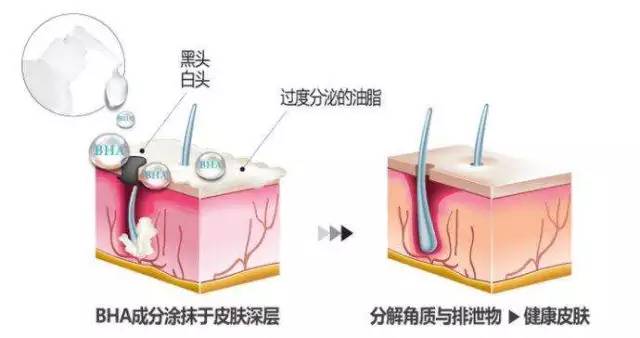 超分子水杨酸焕肤的作用