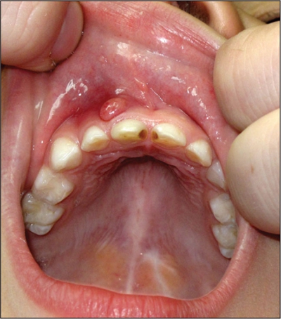 牙龈增生介绍_牙龈增生病因_牙龈增生治疗_牙龈增生