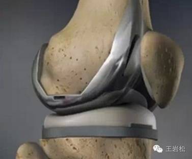 全膝关节置换术:植入的假体能坚持多久?