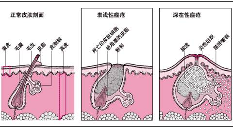 患了痤疮该怎么办