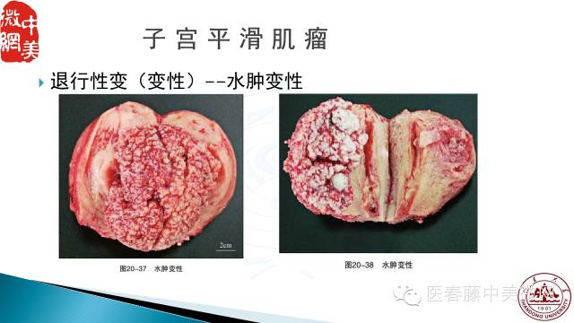 子宫平滑肌瘤到底是怎么回事?