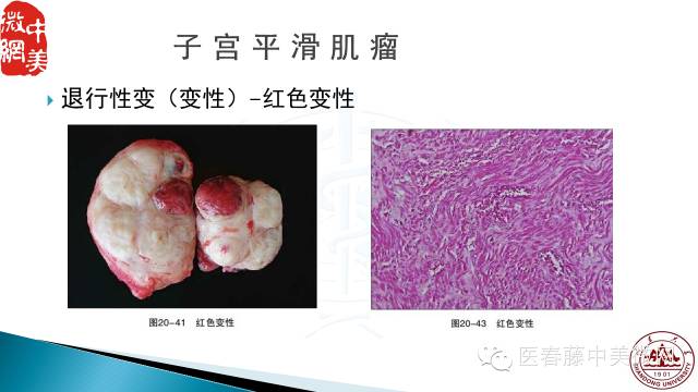 子宫平滑肌瘤到底是怎么回事?