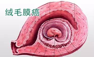 葡萄胎在妊娠早期出现,绒毛膜癌在流产,分娩,宫外孕以后发生