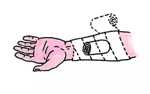 生活常识之外伤止血