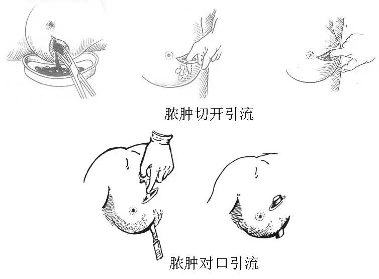 急性乳腺炎脓肿不要急着切开