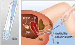 人工授精进行时,老公们应该怎样做呢?