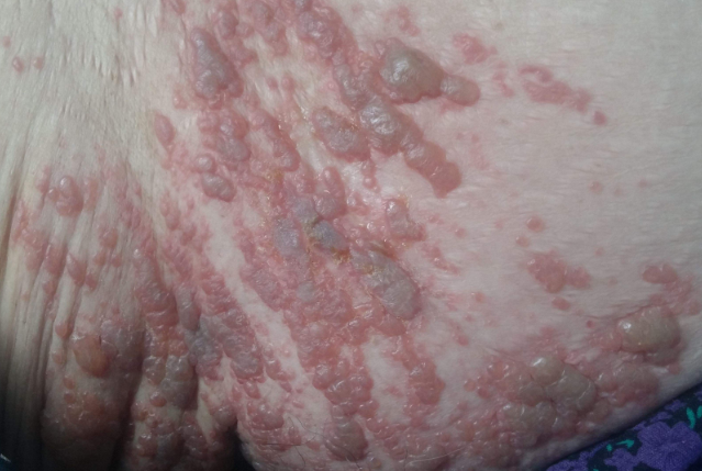 皮肤热毒图片(20)