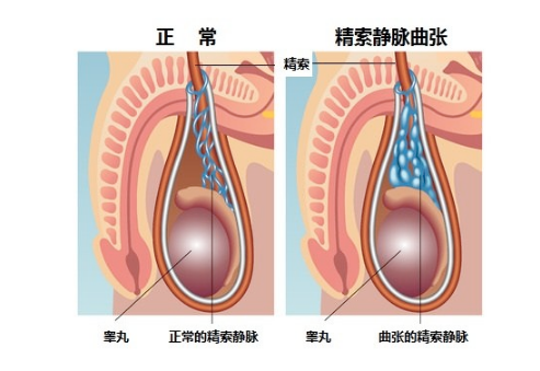 精索曲张睾丸下坠时图片 (46)