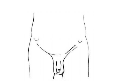 精索曲张睾丸下坠时图片 (43)