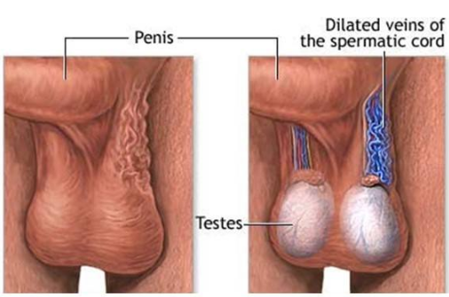 精索曲张睾丸下坠时图片 (9)